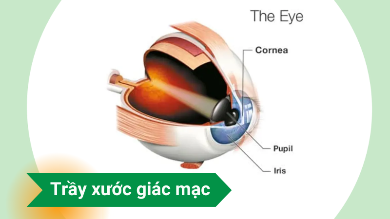 Trầy xước giác mạc (trợt biểu mô giác mạc) là gì?