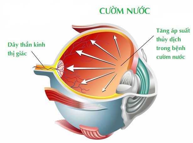 Bệnh Glaucoma (cườm nước) nguyên nhân và cách điều trị