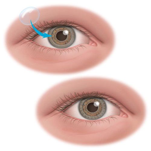 Phương pháp chăm sóc mắt sau phẫu thuật ghép giác mạc