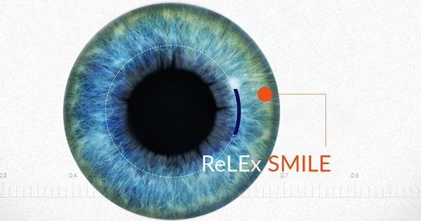 Relex smile – Kỹ thuật chữa tật khúc xạ tiên tiến nhất hiện nay