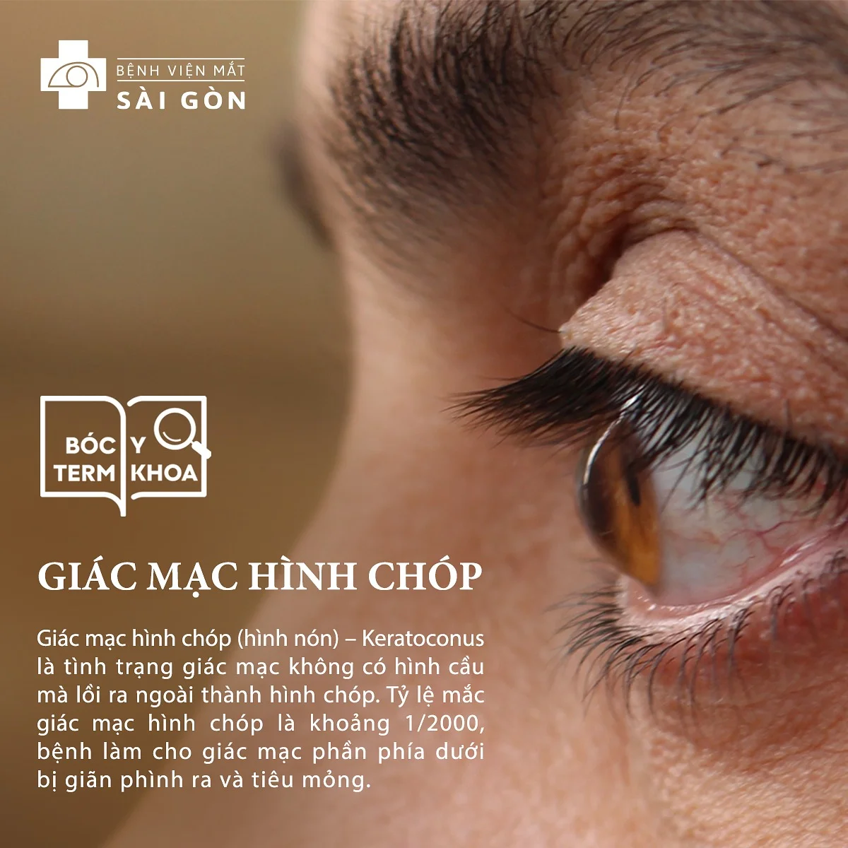 GIác mạc hình chóp