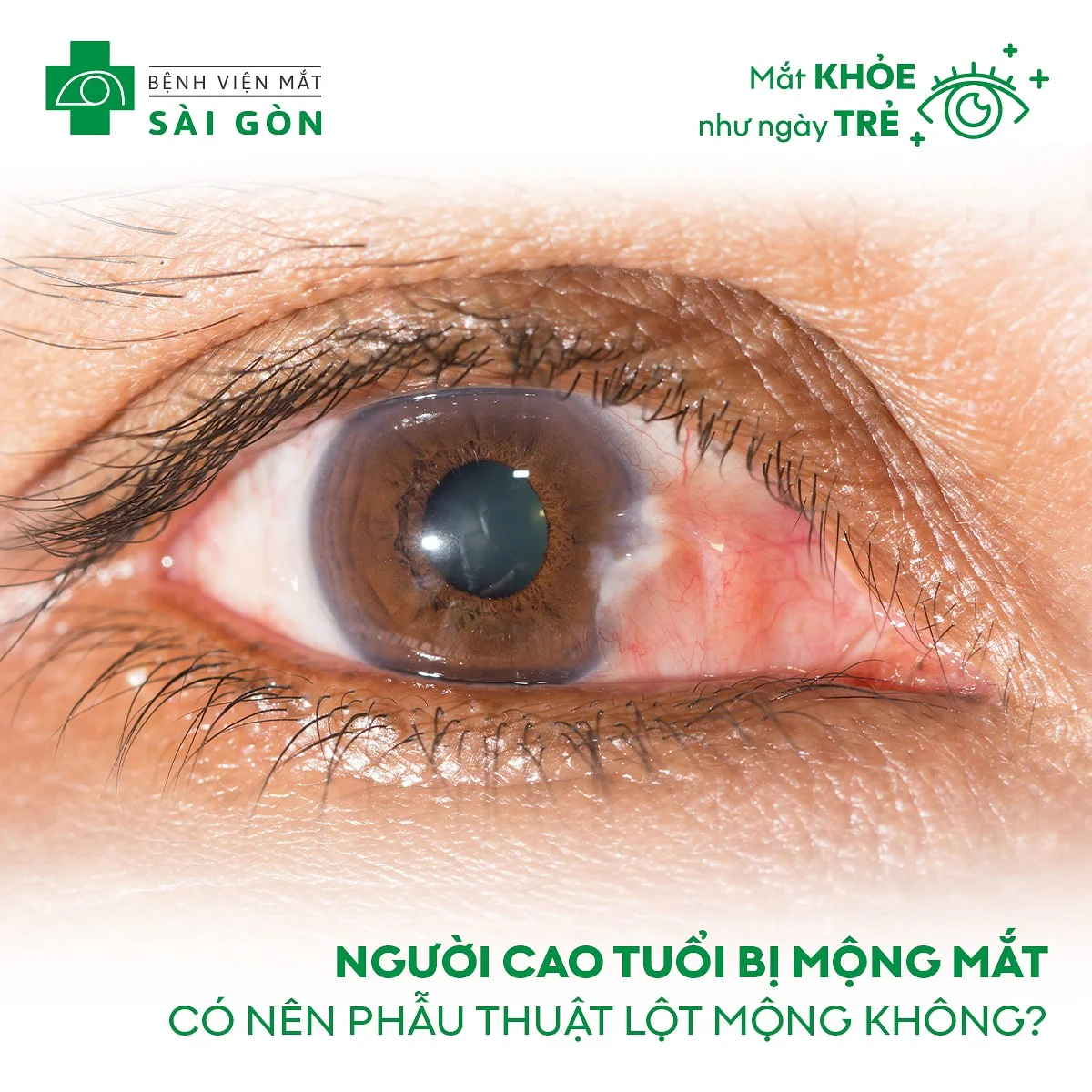 Người cao tuổi bị mộng mắt