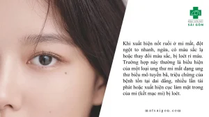 Xác định nốt ruồi 

