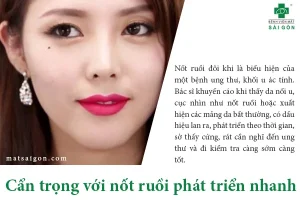 Cẩn trọng với nốt ruồi phát triển nhanh