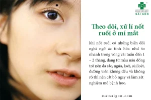 Theo dõi, xử lý nốt ruồi ở mi mẳt