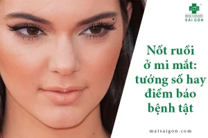 Nốt ruồi ở mi mắt