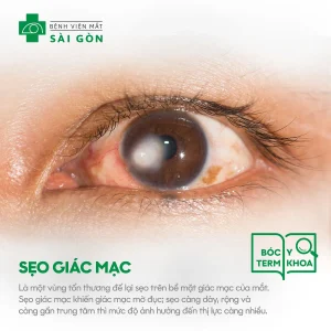 Sẹo giác mạc