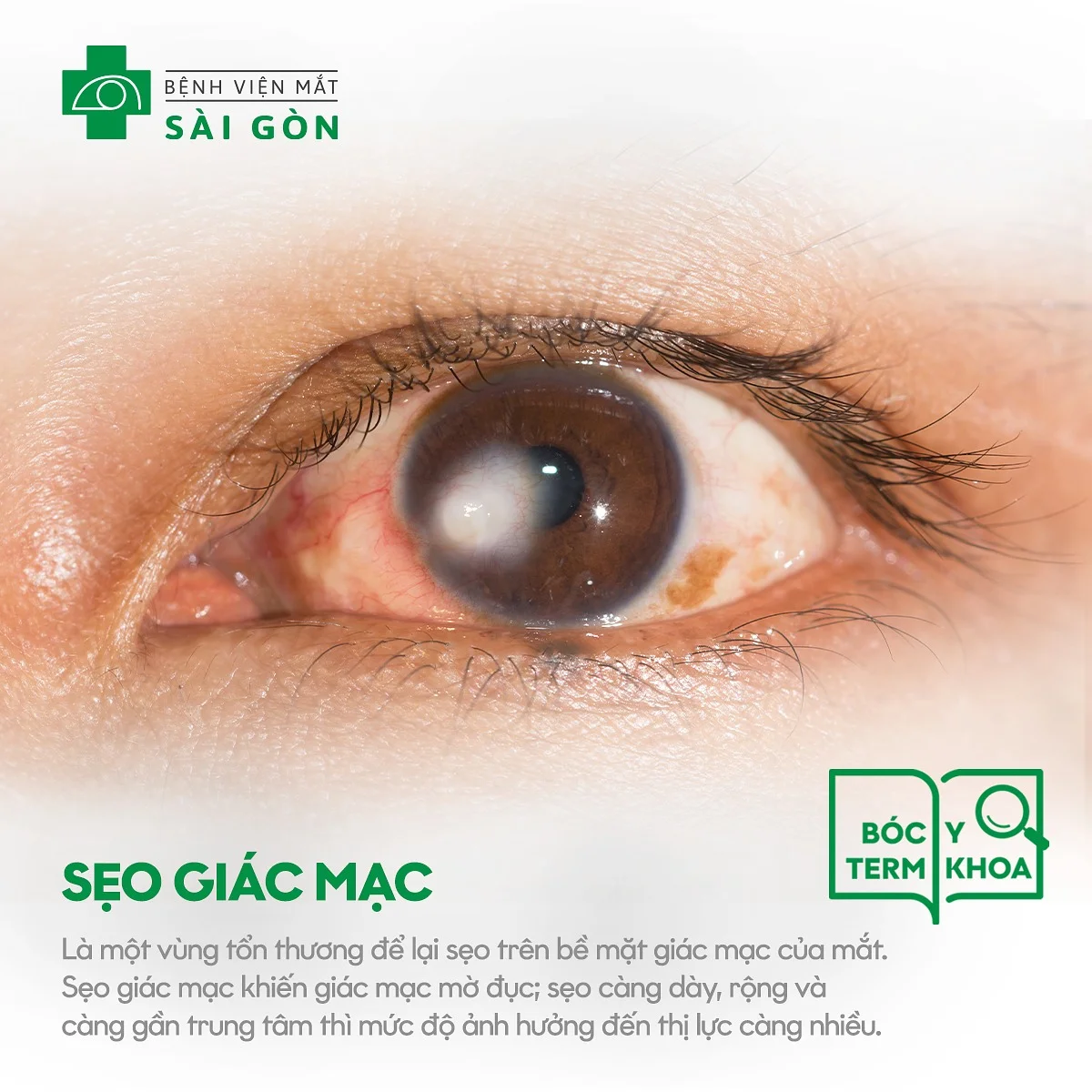Sẹo giác mạc
