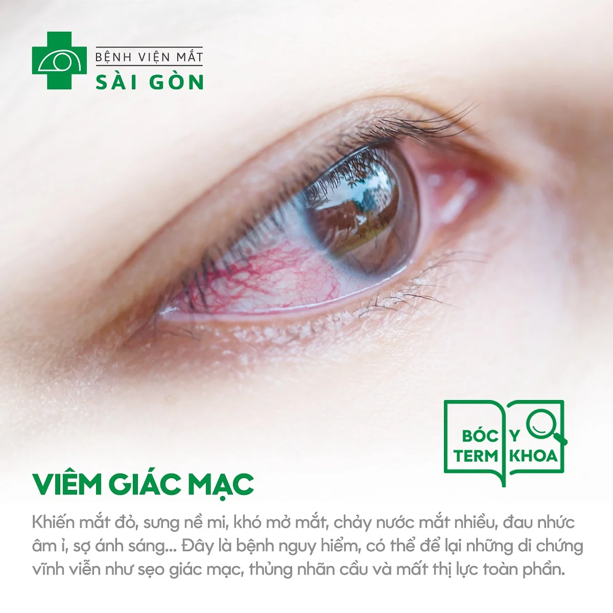 Viêm giác mạc